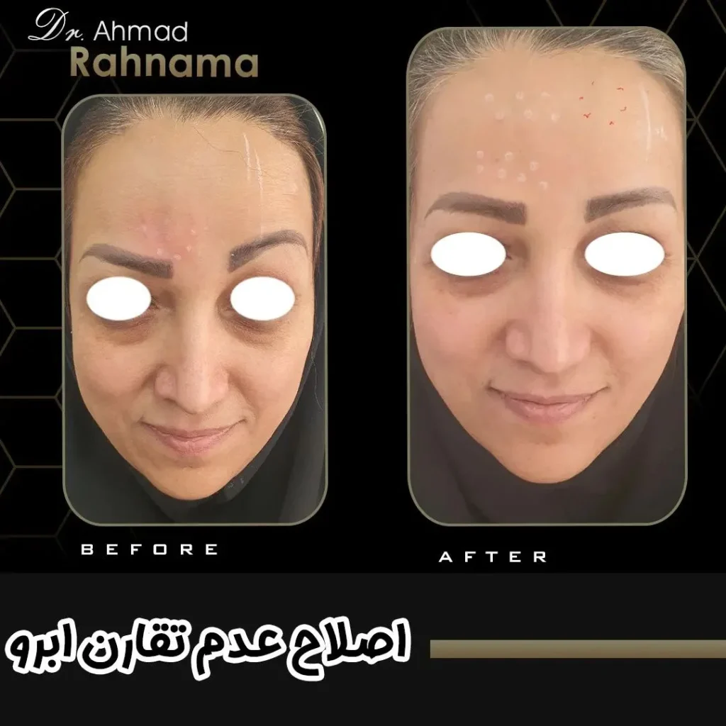 استفاده ار بوتاکس جهت اصلاح غیرقرینگی ابروها
