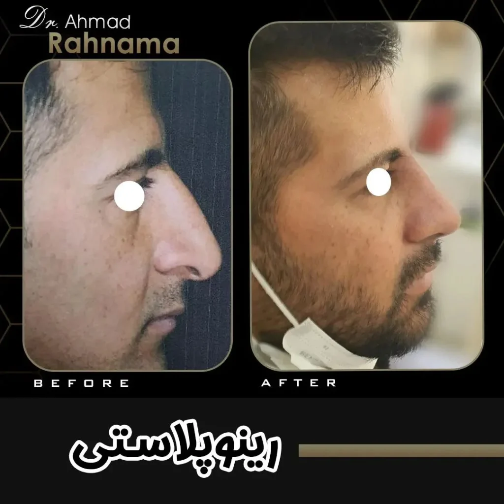 جراحی بینی مردانه