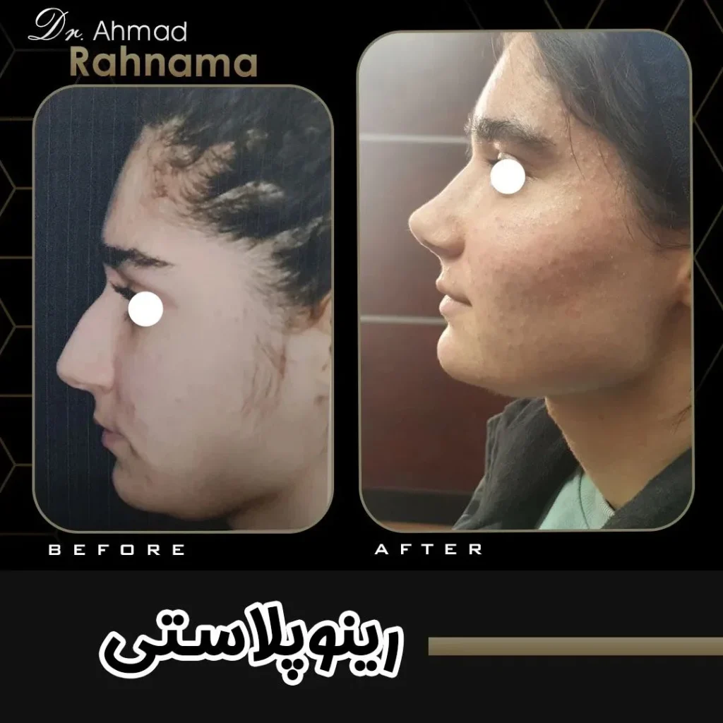 جراحی زیبایی بینی