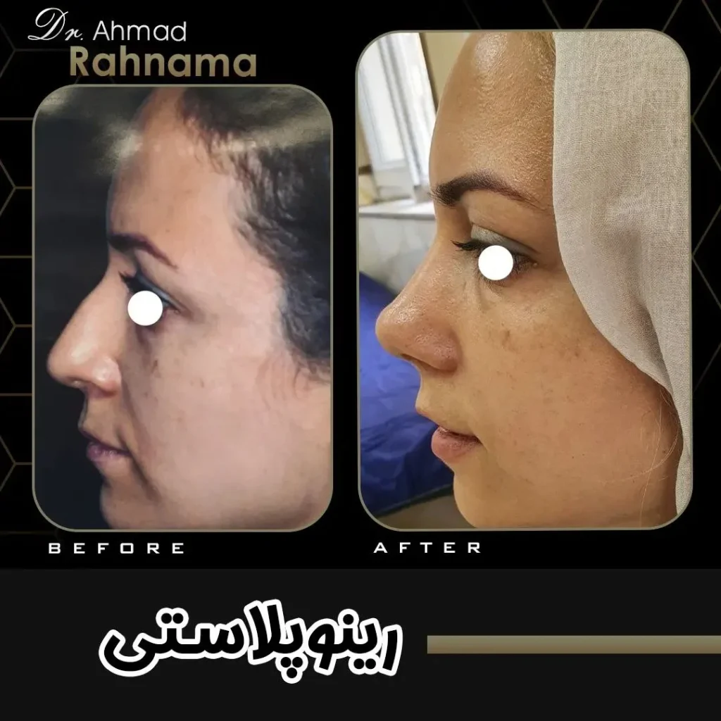 نمونه کار جراحی بینی