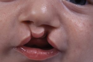 بهترین سن جراحی شکاف لب و کام
