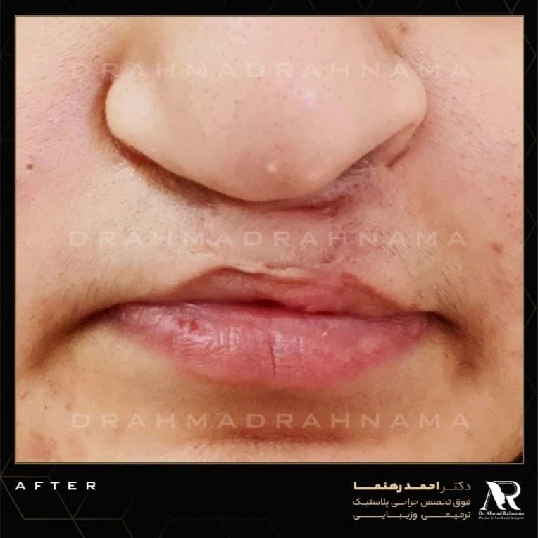 ترمیم شکاف لب و کام