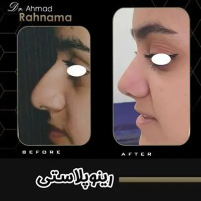 تفاوت جراحی بینی گوشتی با بینی استخوانی