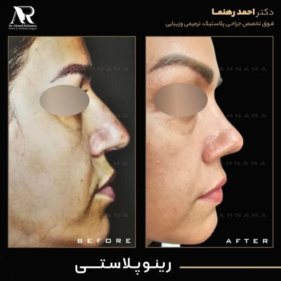 هزینه رینوپلاستی