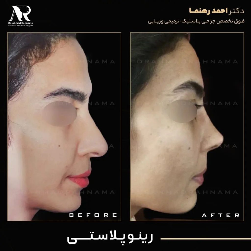 هزینه عمل رینوپلاستی
