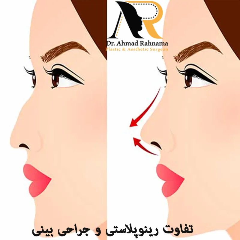 تفاوت-رینوپلاستی-و-جراحی-بینی
