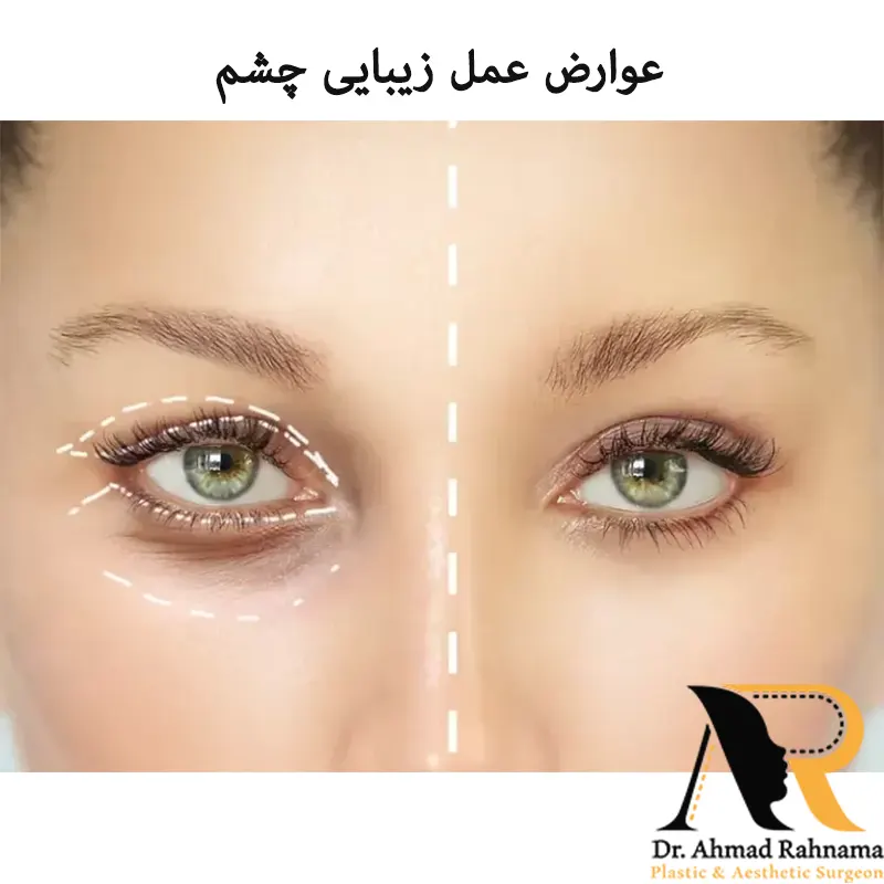 عوارض بعد از جراحی پلک