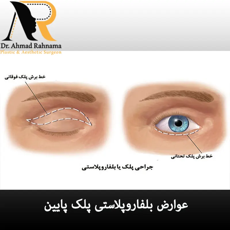 عوارض بلفاروپلاستی