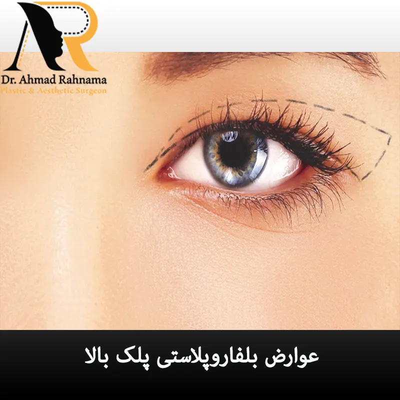 عوارض عمل چشم