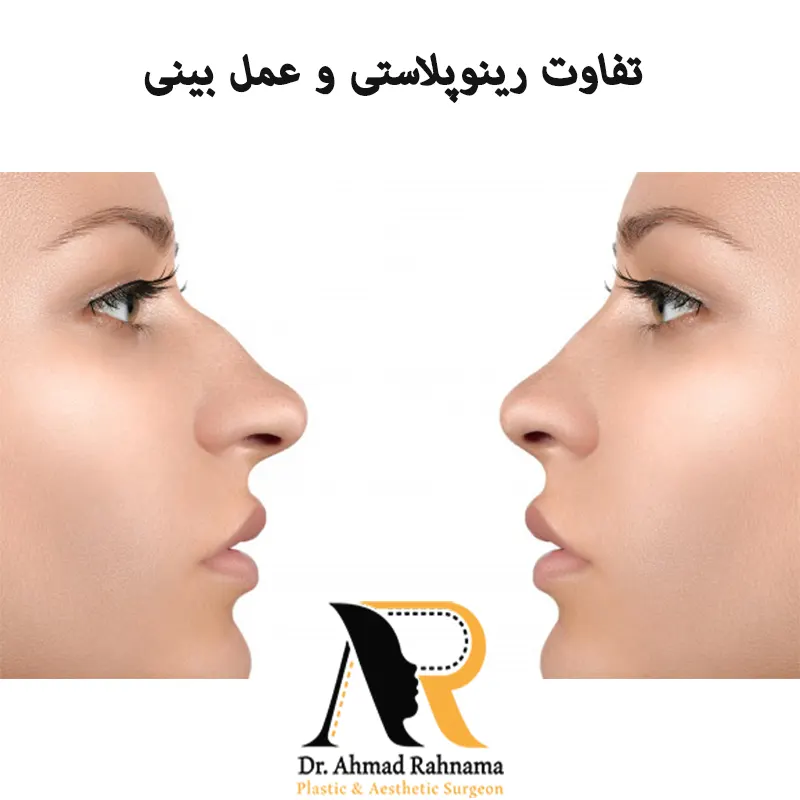 فرق-رینوپلاستی-با-عمل-بینی