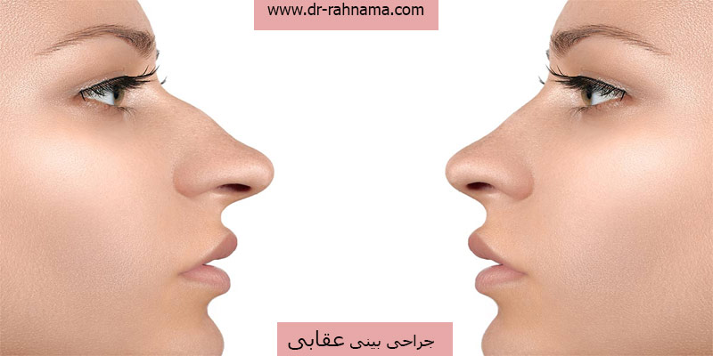 جراحی-بینی-عقابی-چیست؟