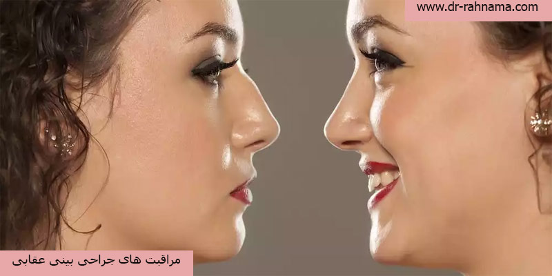 مراقبت-های-پس-از-جراحی-بینی