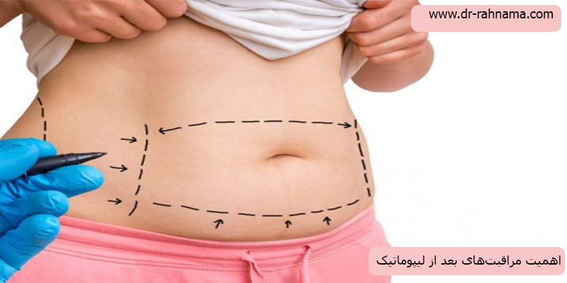 مراقبت-های-بعد-از-لیپوماتیک