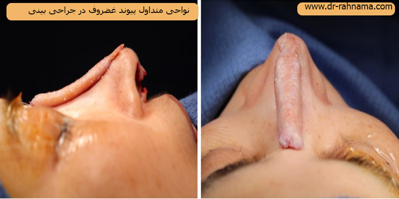 نواحی-متداول-پیوند-غضروف-در-جراحی-بینی