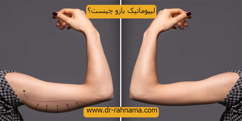 لیپوماتیک-بازو-چیست؟
