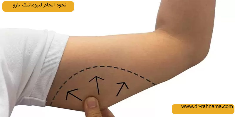 نحوه-انجام-لیپوماتیک-بازو