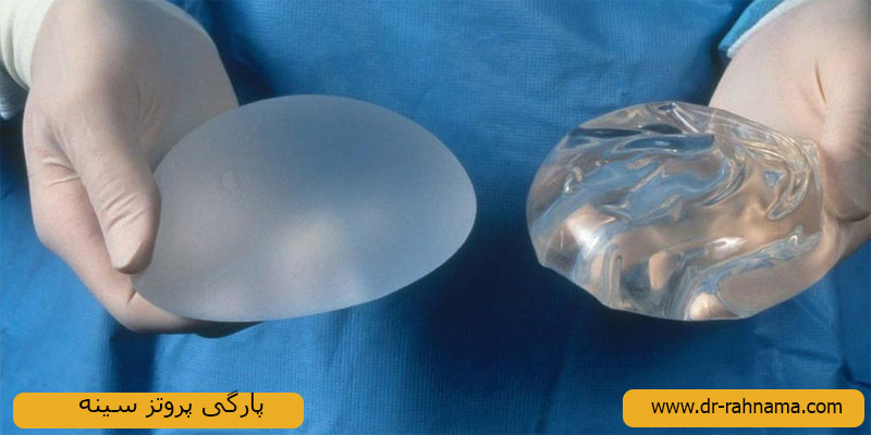پارگی پروتز-سینه