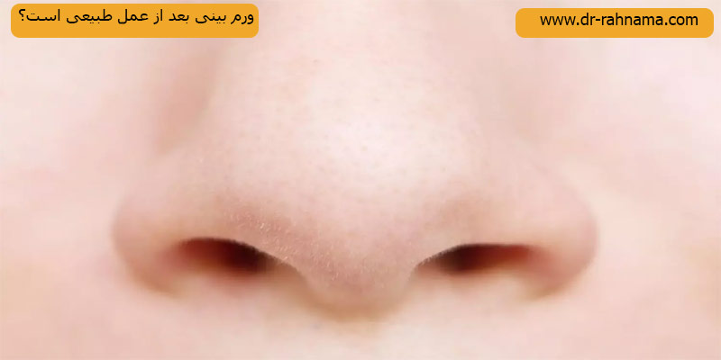 ورم-بینی-طبیعی-است