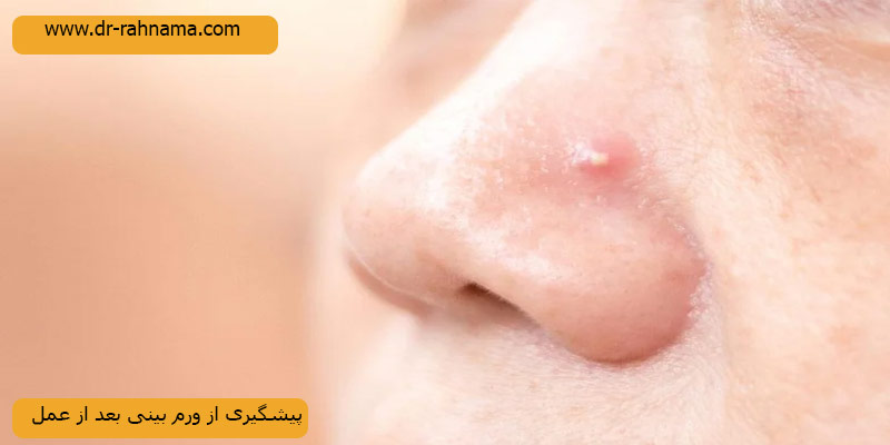 پیشگیری از ورم-بینی