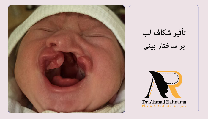 تأثیر شکاف لب بر ساختار بینی