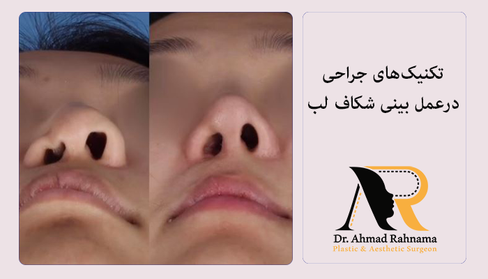 روش های جراحی درعمل بینی شکاف لب