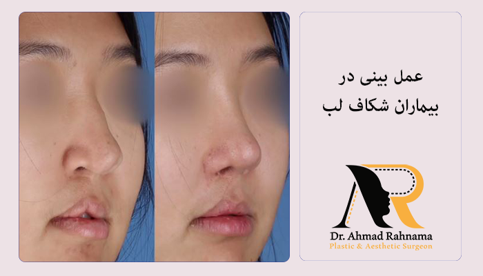عکس عمل بینی در بیماران با شکاف لب