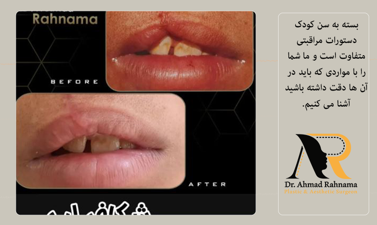 مراقبت های بعد از شکاف لب یر اساس سن