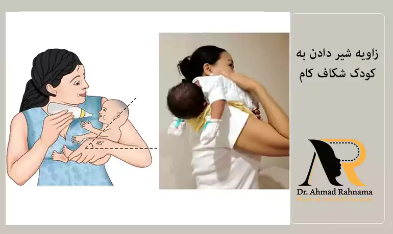 مراقبت های تغذیه ای قبل از جراحی شکاف لب و کام در کودکان