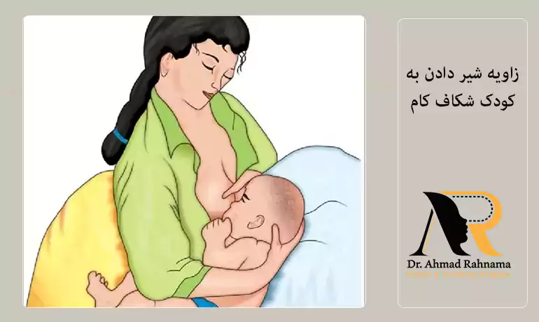 مراقبت های شیر دهی قبل از جراحی شکاف لب و کام در کودکان