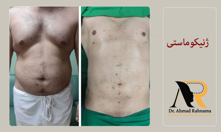 تفاوت-ژنیکوماستی-و-چربی