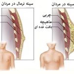 ژنیکوماستی