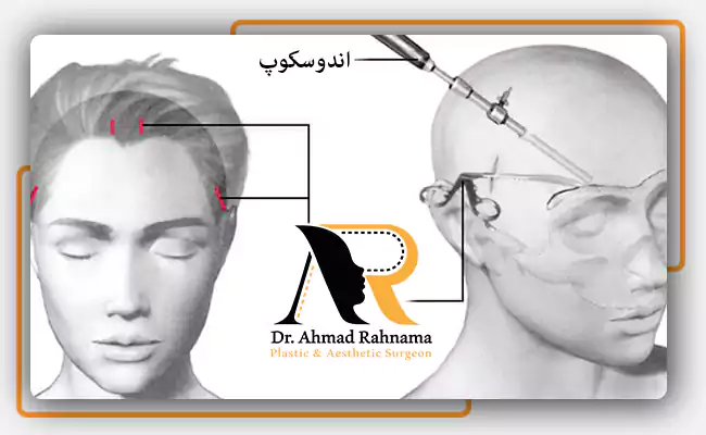 لیفت ابرو با اندوسکوپ چگوته انجام می شود؟