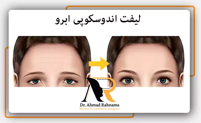 لیفت اندوسکوپی ابرو